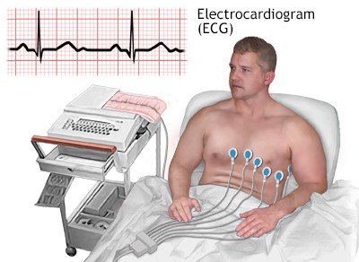 What is an ECG A male patient sitting on a bed is undergoing an electrocardiogram (ECG) test, with electrodes attached to his chest and a monitoring machine nearby. A graph displaying the ECG waveform is shown above.